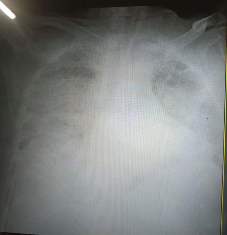 Легені хворих на COVID-19
