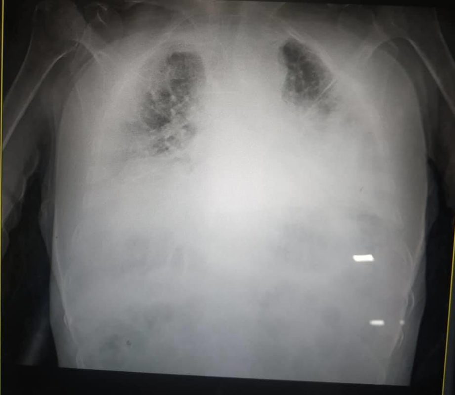 Легені пацієнтів, хворих на COVID-19