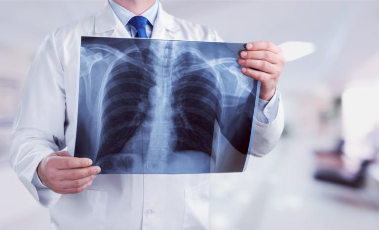 Як швидко легені відновлюються після COVID-19: медики дали відповідь