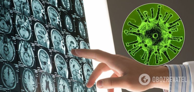 Вчені встановили, як пошкодження мозку впливає на виживаність при COVID-19