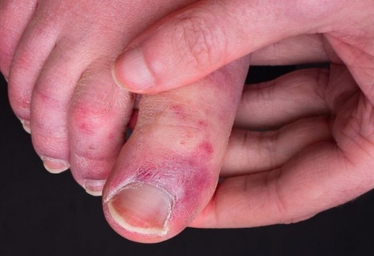 “Ковідні пальці”: вчені розповіли про рідкісний побічний ефект