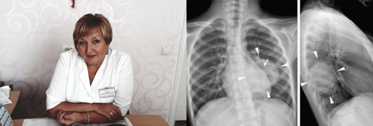 “Штам “Дельта” викликає “невидиму” пневмонію з тромбозами, названо тривожні ознаки”: лікарка про наслідки хвороби