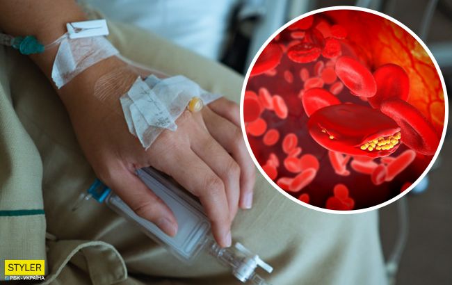 Українців попередили про ризик смерті від тромбозу внаслідок коронавірусу: названо симптоми