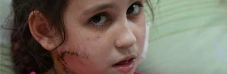 Воюють проти дітей: російський окупант вистрелив в обличчя 11-річній дівчинці (ВІДЕО)
