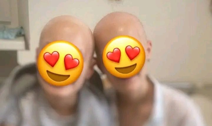 Через бажання схуднути 13-річні сестрички довели себе до повного випадіння волосся та відшарування шкіри