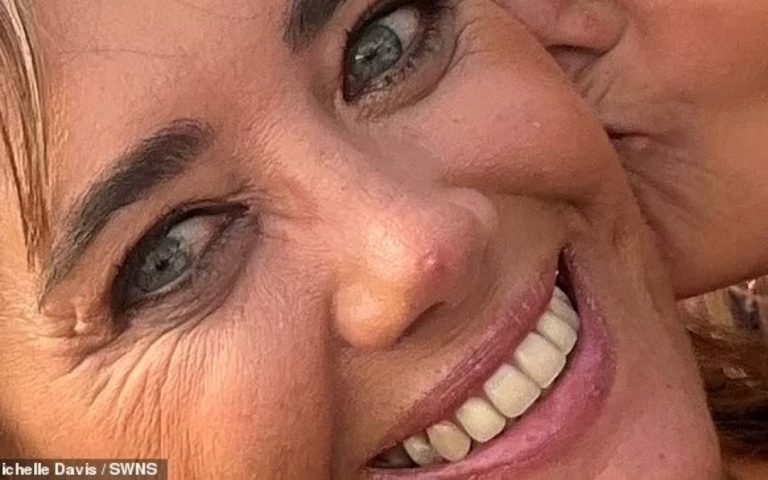 Жінка видавлювала “прищ” на носі, який виявився раком шкіри: які симптоми вона ігнорувала